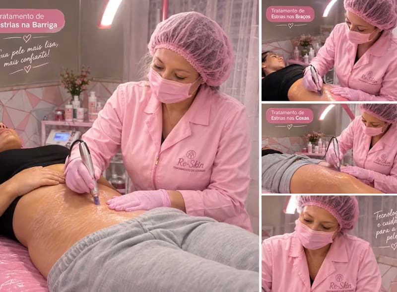 Sessão de tratamento de estrias do Método Re-Skin